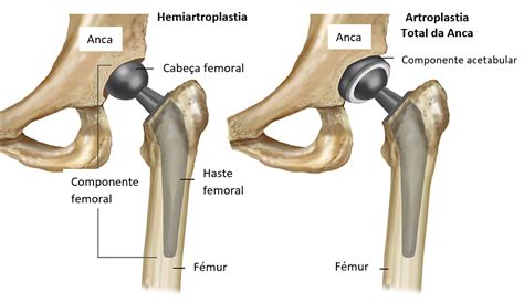 artroplastia da anca